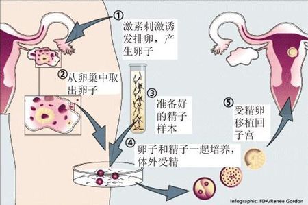 42岁PGT成功案例